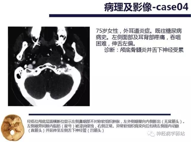 舌下神经和舌咽神经的解剖图,颊神经舌神经解剖图
