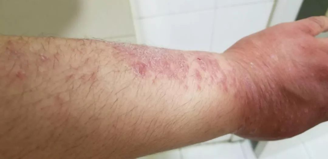 娴欐睙鐪佷腑鍖绘不鐤楅摱灞戠梾,鍏勫紵淇╅兘寰楃櫧鐧滈