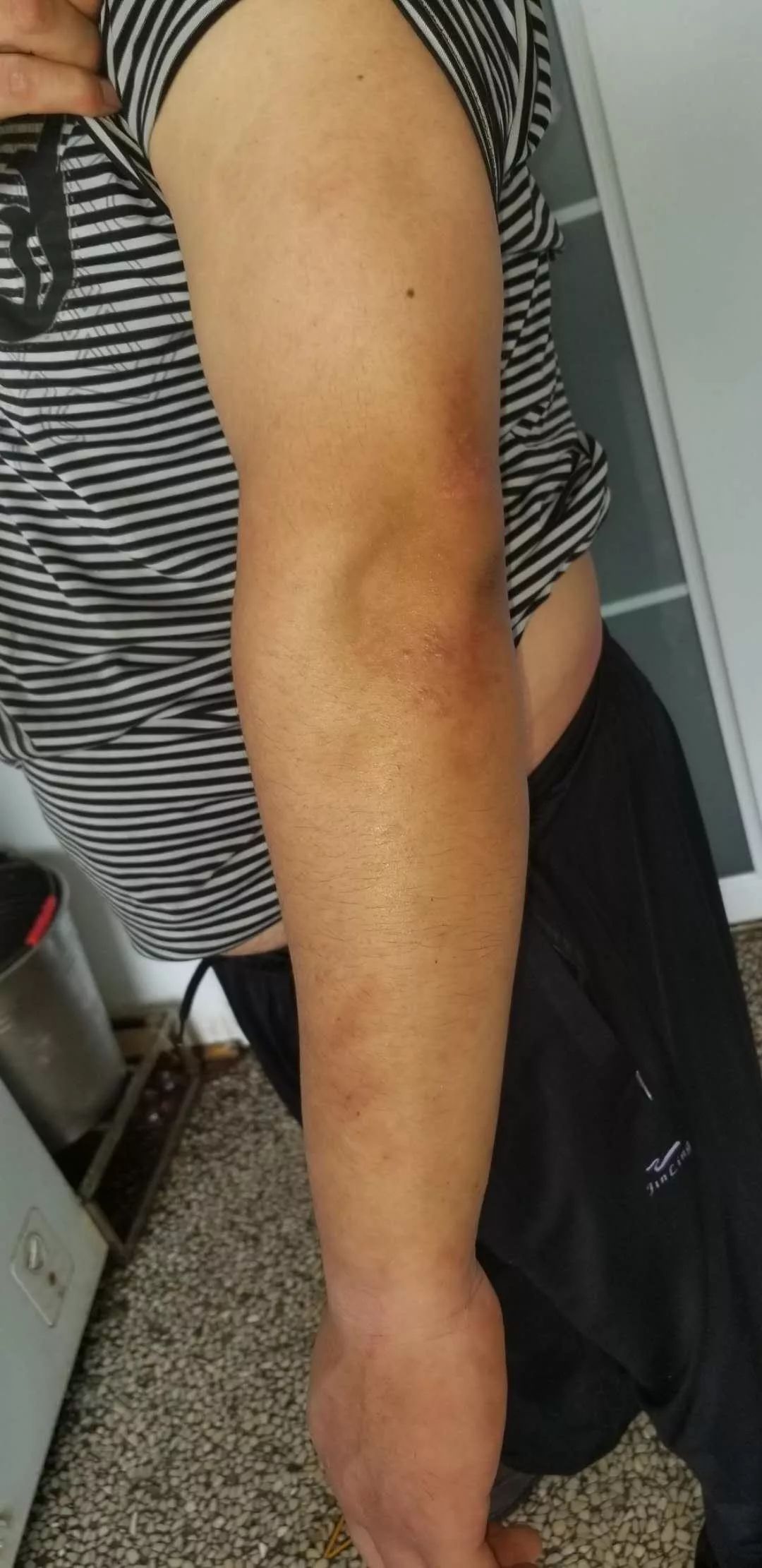 娴欐睙鐪佷腑鍖绘不鐤楅摱灞戠梾,鍏勫紵淇╅兘寰楃櫧鐧滈