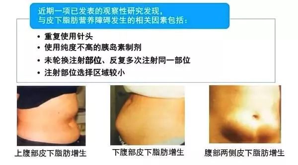 推介一款胰岛素无针注射器,胰岛素注射泵推荐