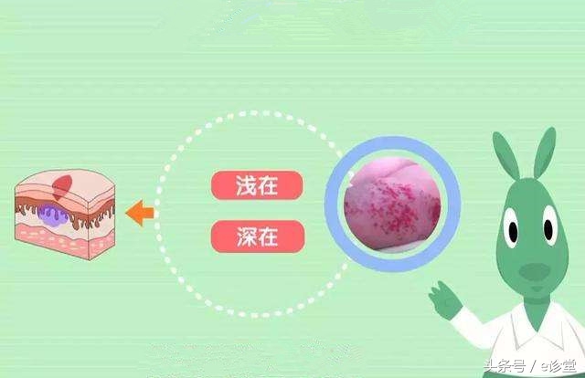 血管瘤常见问题之:海绵状血管瘤的诊断及治疗!