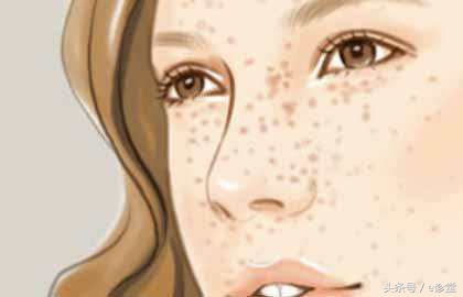 雀斑小常识：如何告别脸上的“小点点”？
