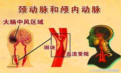 长期药物治疗可以减轻冠状动脉狭窄、减少心绞痛和心梗发生