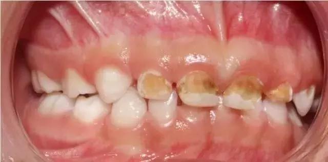 关注儿童牙齿健康不容忽视,对于儿童的牙齿是否重视