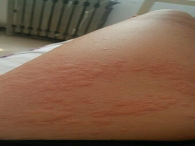 接触过麻疹病人多久排除传染可能,小孩子出麻疹要怎么预防传染呢