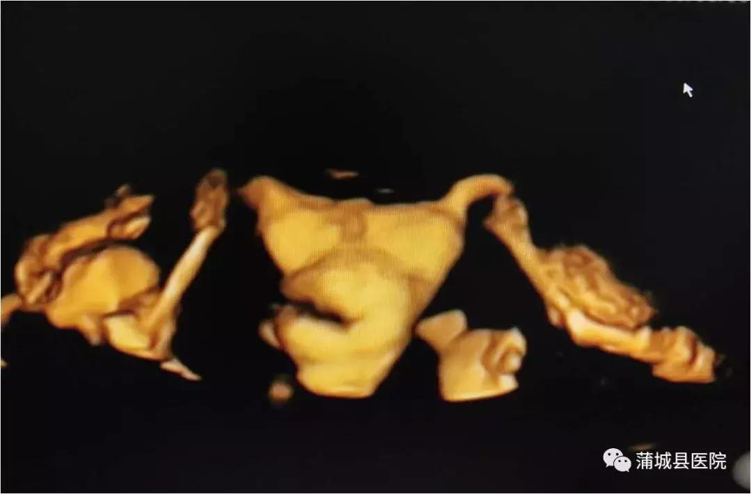 蒲城县做造影,蒲城县妇科超声