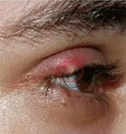 看了不该看的？4岁女童长了一粒小“针眼”,差点丧命！只因为奶奶……