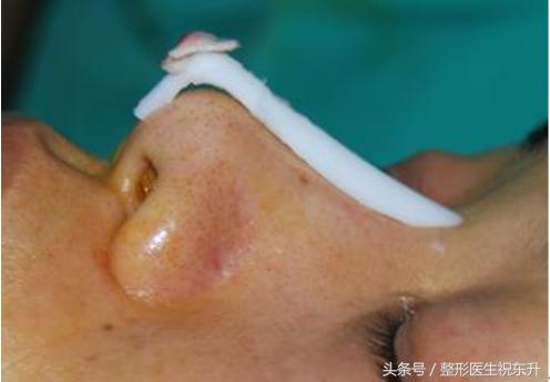 医生不会说的真相,隆鼻后鼻尖一直红是怎么回事