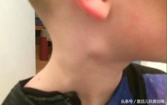 脖子上喉咙部位摸到一个小疙瘩,脖子上摸到会动的疙瘩怎么回事