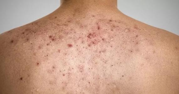 背上痘痘太多,背上长痘痘解决小妙招医生