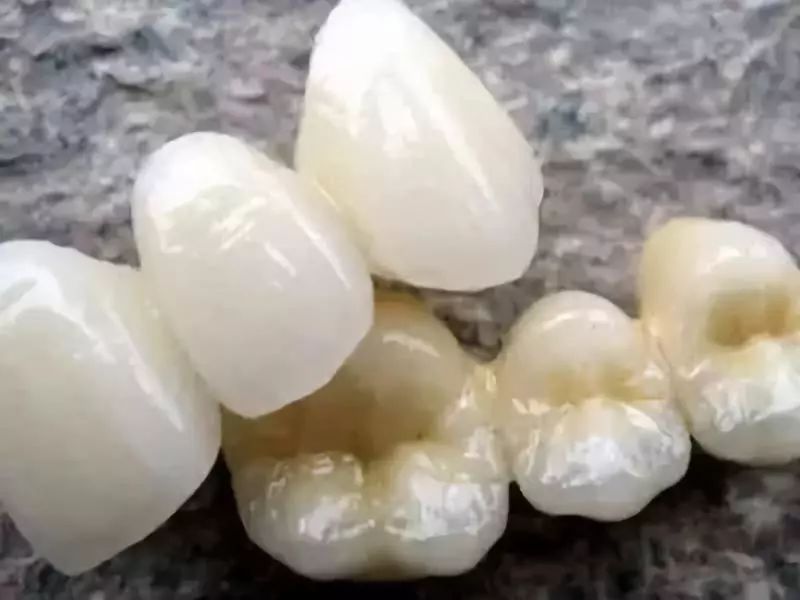 烤瓷牙与全瓷牙价格对比,烤瓷牙和全瓷牙价格差多少钱一颗