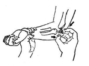 中医骨折治疗原则,中医骨伤整复术