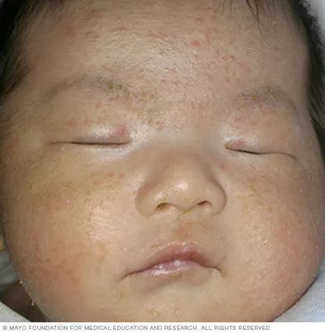 新生儿脸上长红色小疹子,新生儿白色颗粒疹子