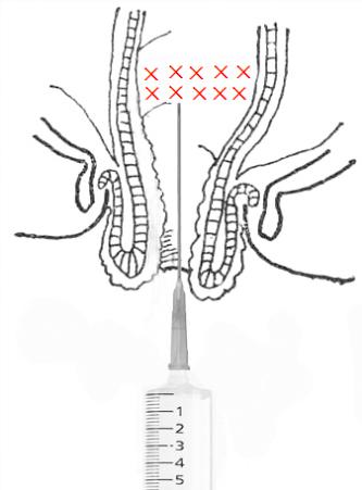 「中医适宜技术」第九篇肛肠类技术｜第5章注射固脱