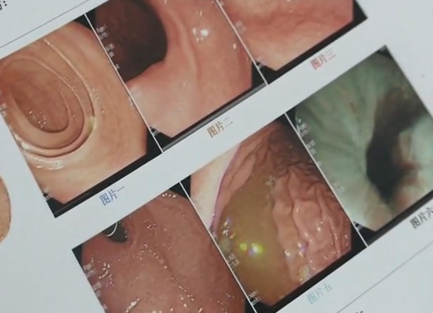 湖北：女子深夜管不住嘴追剧时狂吃这零食因胃出血被送进医院……