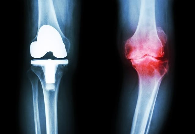 老年人骨质增生的原因有哪些,老年人腰部骨质增生怎么治疗最好