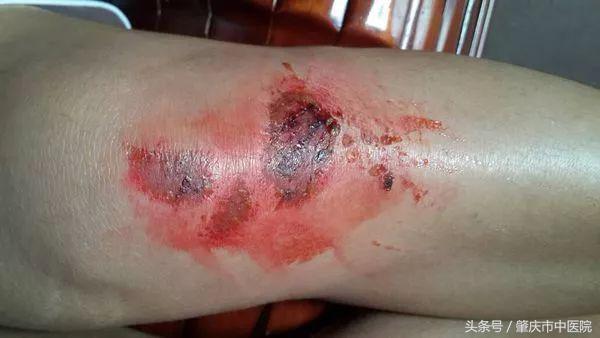 红药水和碘酒有什么区别,碘酒加红药水禁忌图片