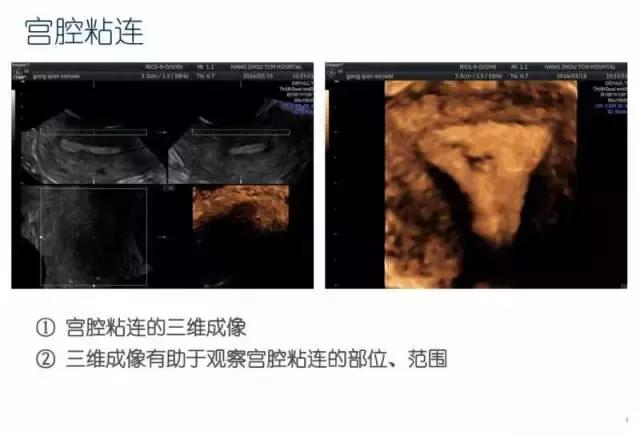 妇科盆腔彩超探头,妇科超声波探头