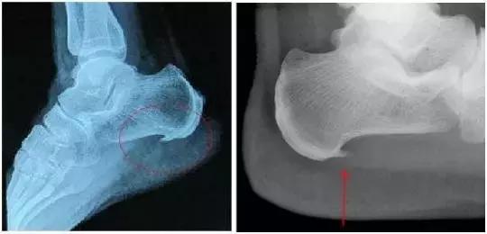 脚后跟疼是肾有问题么,专治脚后跟疼的骨刺特效药