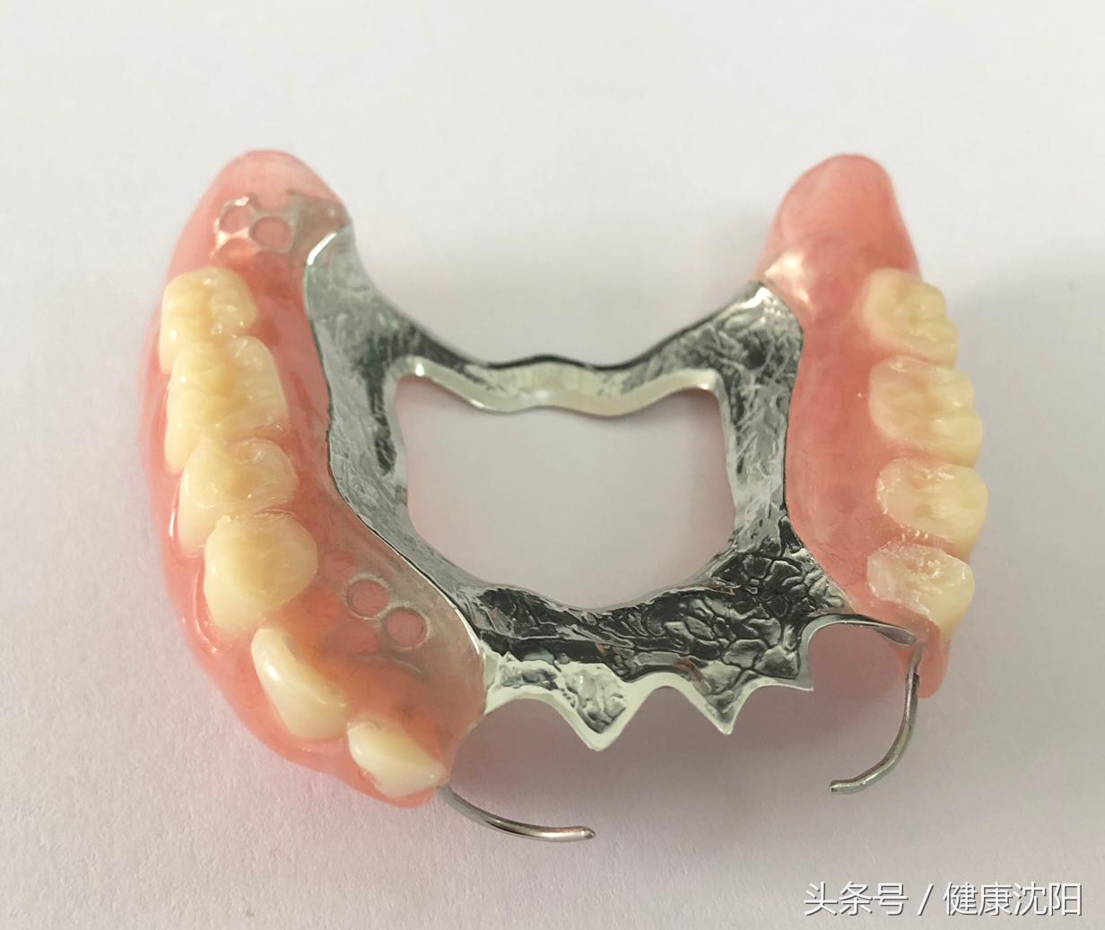 拔牙后一般多久能镶牙,拔牙过后一般多久才能镶牙