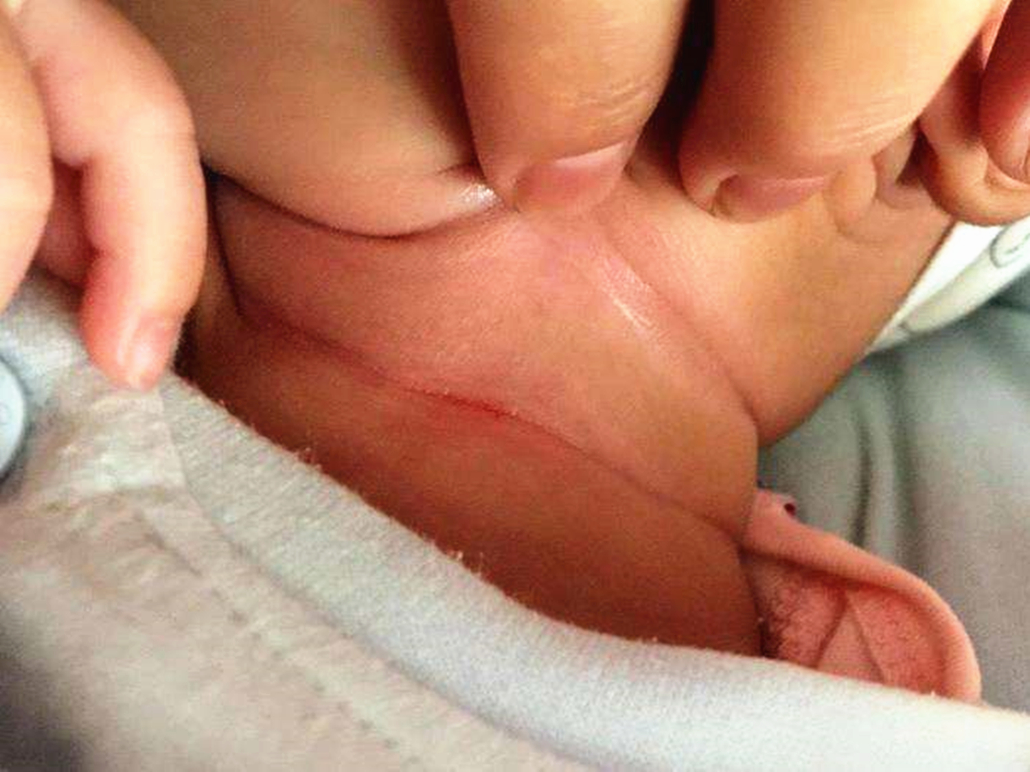 宝宝脖子淹很红了怎么快速恢复,宝宝脖子淹红了怎么快速恢复