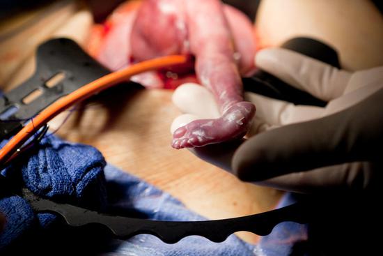 这位医生能给没出生的胎儿做手术甚至能修复脊柱