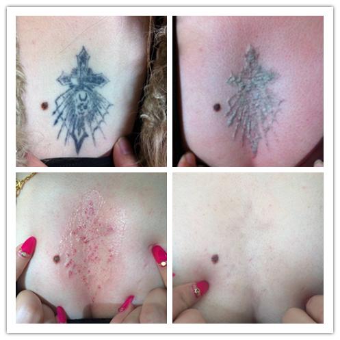 洗纹身咨询李医生,昆明李医生洗纹身是真的吗