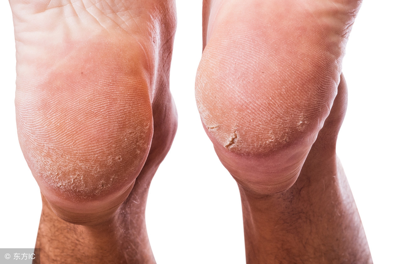 脚后跟鱼鳞状干裂用什么药,小腿后跟干裂起鱼鳞是什么原因