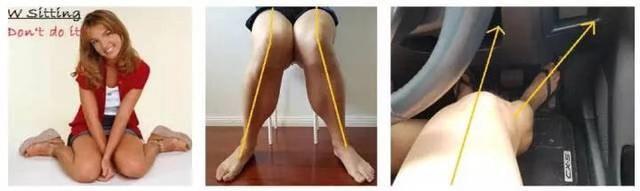 如何改善膝盖内旋腿型,膝盖老是向前弯曲