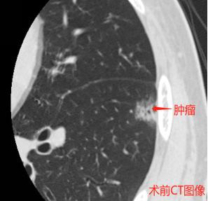 微创医疗最新突破,首例单孔胸腔镜手术