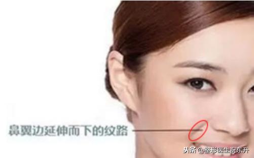 消除法令纹做什么项目,消除法令纹按什么穴