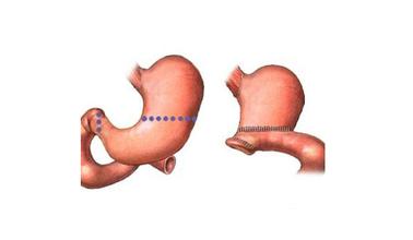 胃手术后能吃雅培的全安素吗,胃癌术后可以吃雅培全安素吗