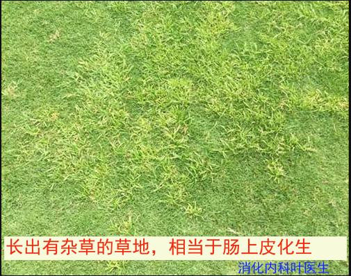 广泛肠上皮化生与肠上皮化生区别,肠上皮化生一定会癌变吗