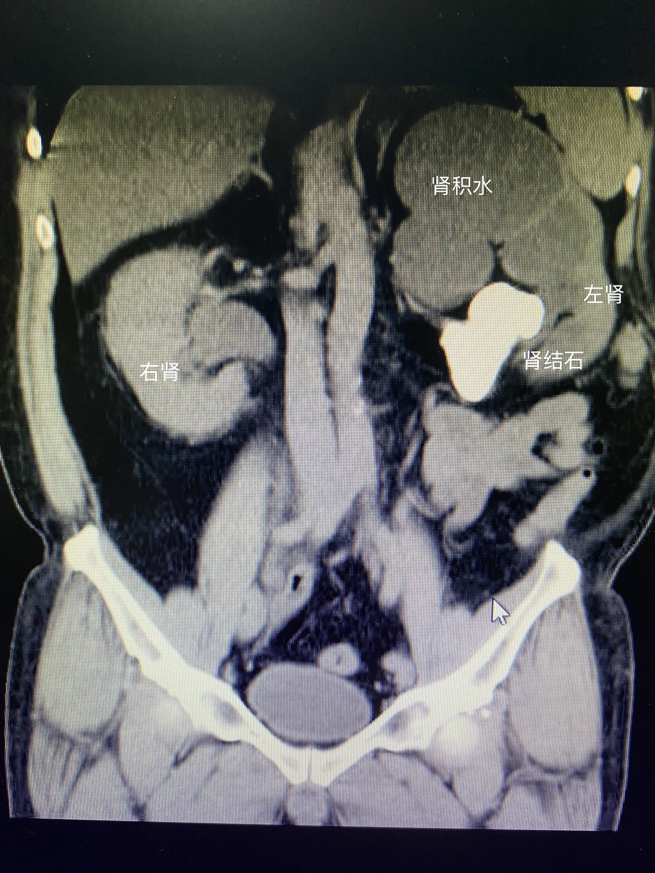 体检时说左肾有结石,医院怎样治疗肾结石好