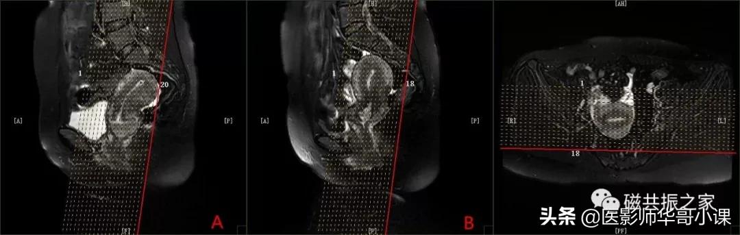 「精品课件」带大家看看,磁共振子宫MRI要如何扫描?