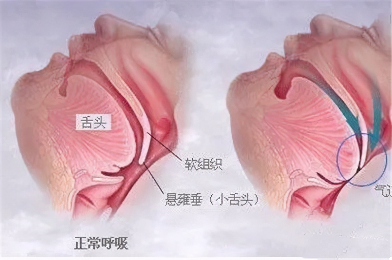 高血压脑出血急救视频,高血压脑出血急救最快的方法
