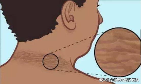 脖子发黑怎么都洗不干净怎么办,脖子发黑洗不掉像脏兮兮怎么办