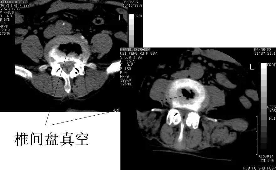 颈椎腰椎疾病ct及mri诊断,腰椎ct可以发现肠部病变吗
