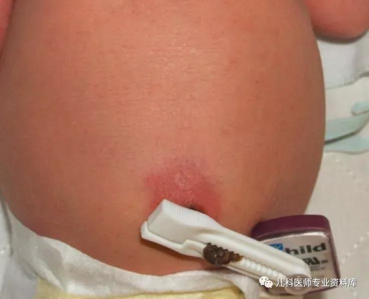 脐部护理的介绍,新生儿脐部护理