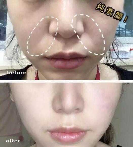 硬刚女皇龙妈也扛不住法令纹,2条沟壑让人心疼,贴一贴就消了