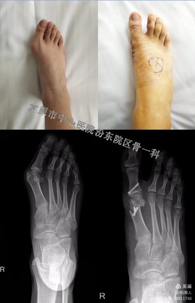 太原中心医院汾东院区骨科,太原汾东中心医院骨科拇外翻大夫