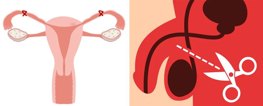 丈夫结扎妻子怀孕,太扎心男子2次结扎妻子怀孕