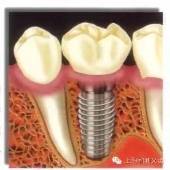 韩国进口登腾种植牙全瓷冠,韩国进口登腾种植牙