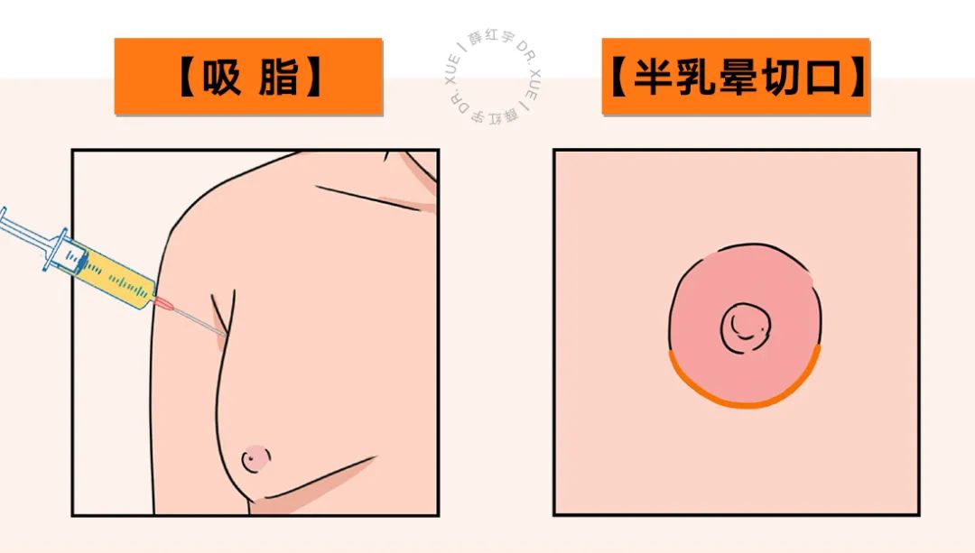 乳房缩小常见术式,乳房缩小术解除乳房过大的烦恼
