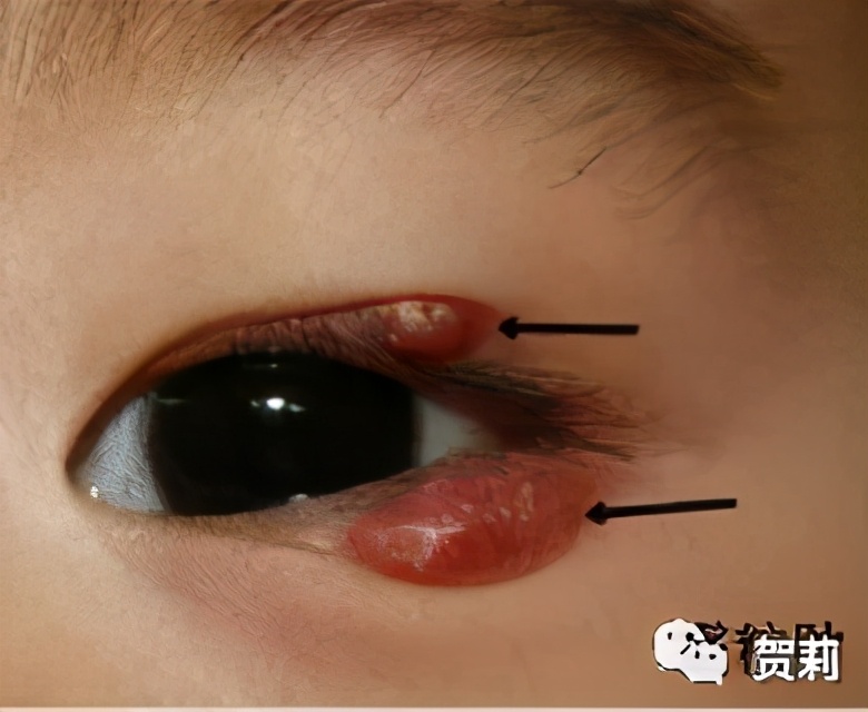 睑板腺囊肿眼皮图片,睑板腺囊肿眼皮肿怎么办