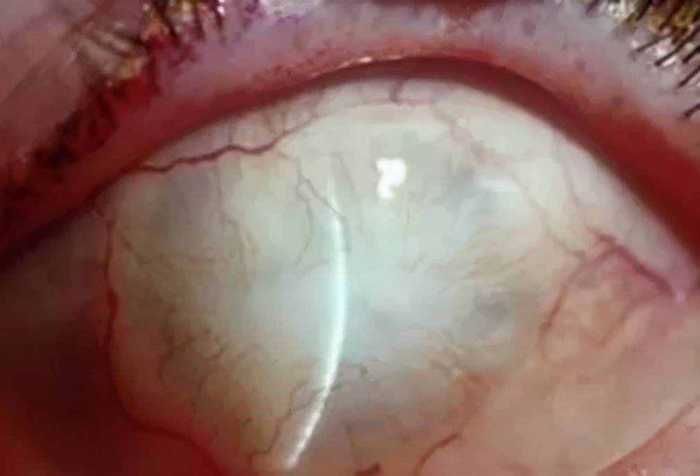 眼化学伤的图片,眼化学伤的急救处理