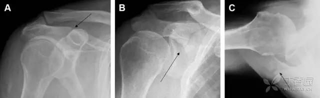 值夜班急救措施,放射科容易漏诊的骨折