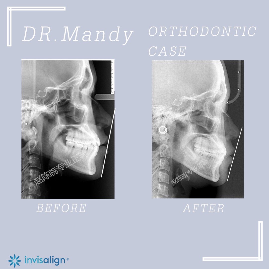 厦门牙齿矫正前后对比,牙齿矫正对脸型的改变有多大知乎