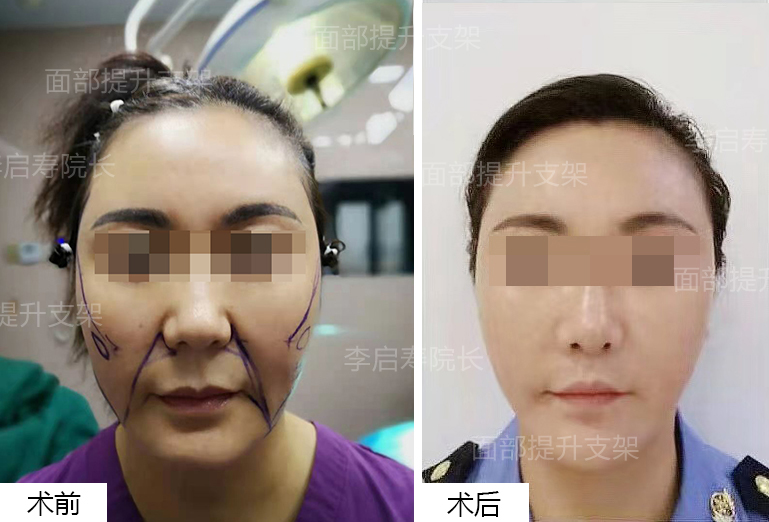40岁做了线雕的前后图片,40岁以上法令纹下垂医美