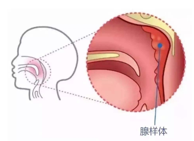 儿童腺样体肥大张口呼吸怎么矫正,小孩腺样体肥大怎么解决张嘴呼吸
